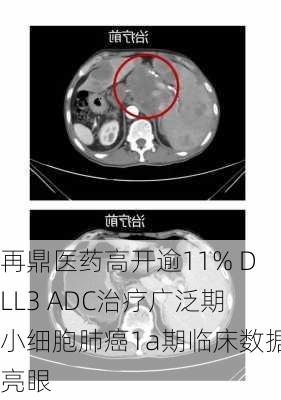 再鼎医药高开逾11% DLL3 ADC治疗广泛期小细胞肺癌1a期临床数据亮眼